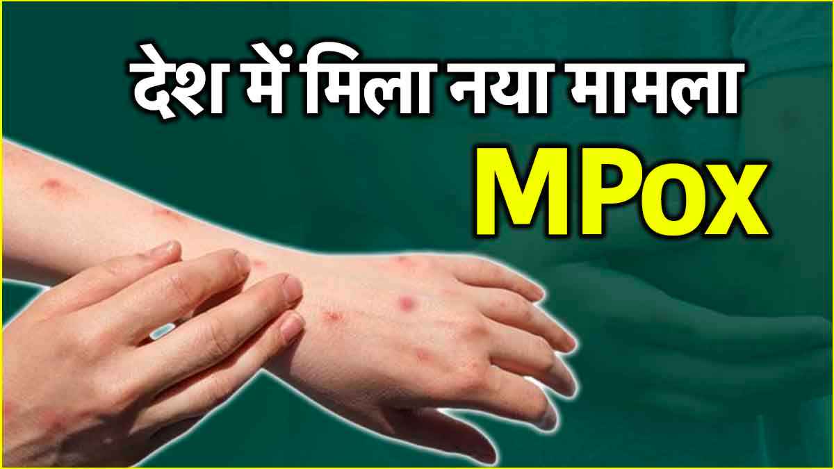 देवरिया में मिला मंकीपॉक्स का संदिग्ध, जानें बीमारी के शुरुआती संकेत और बचाव के उपाय