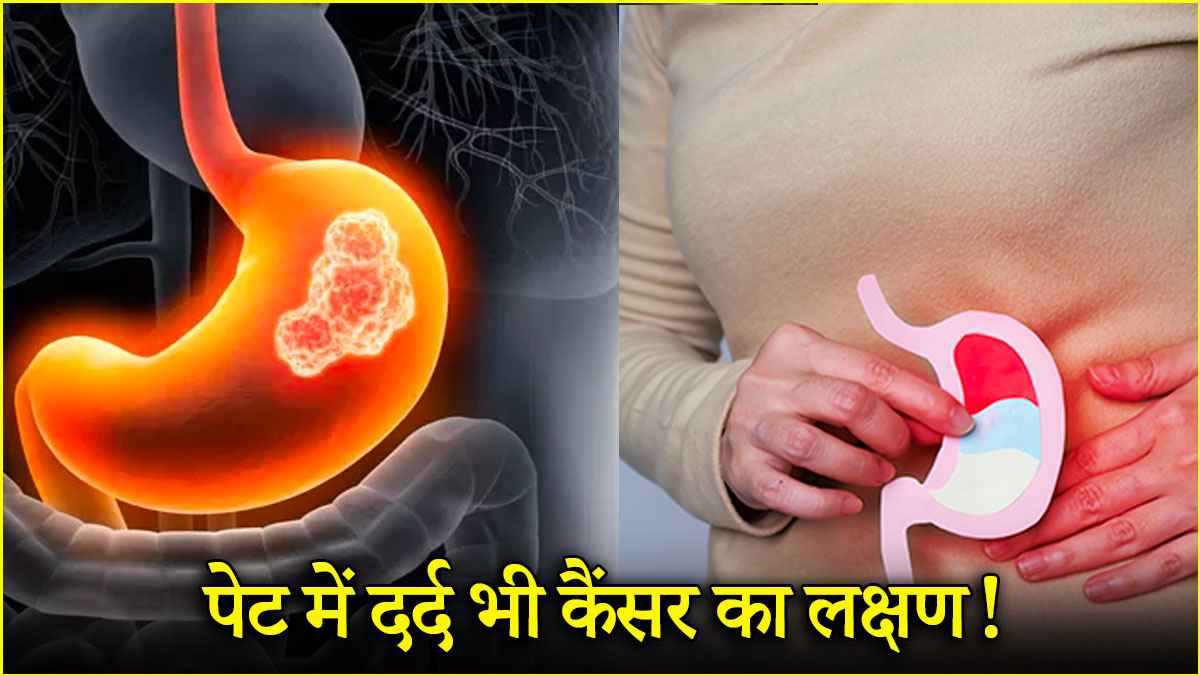 Stomach Cancer