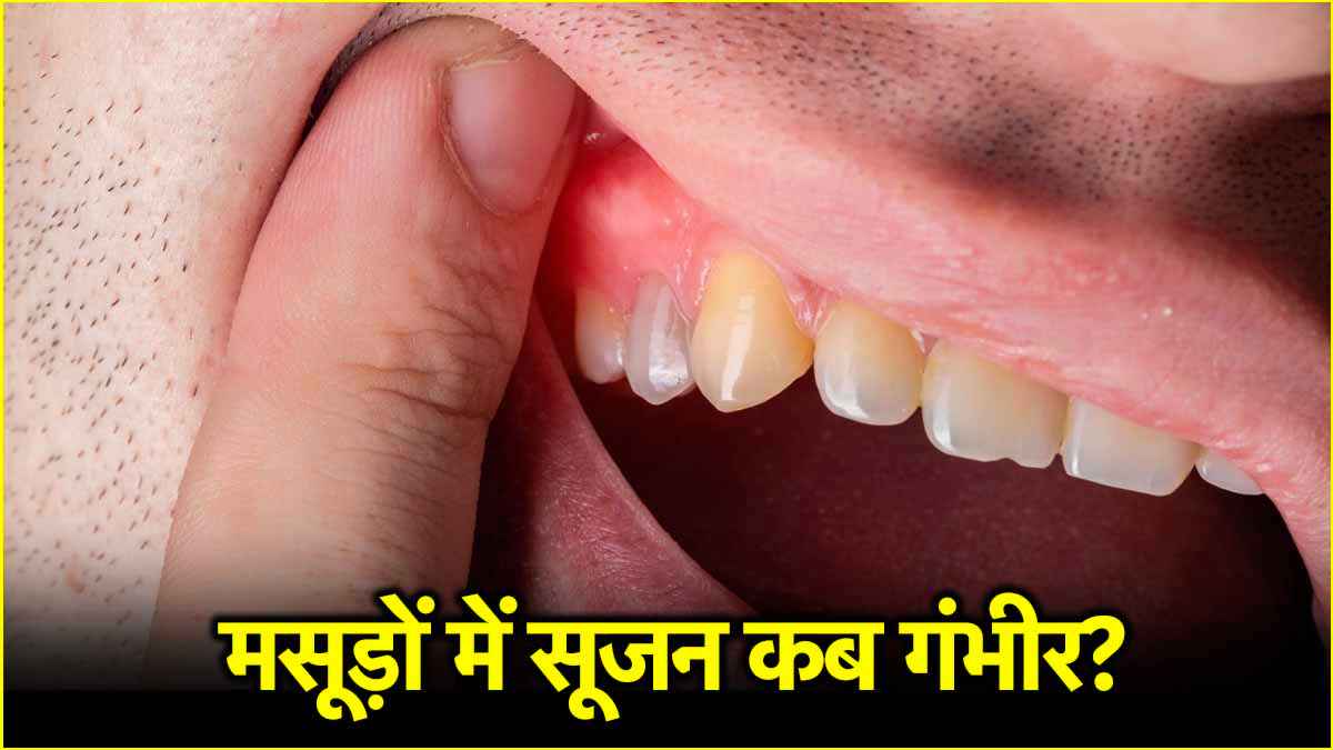 swollen-gums