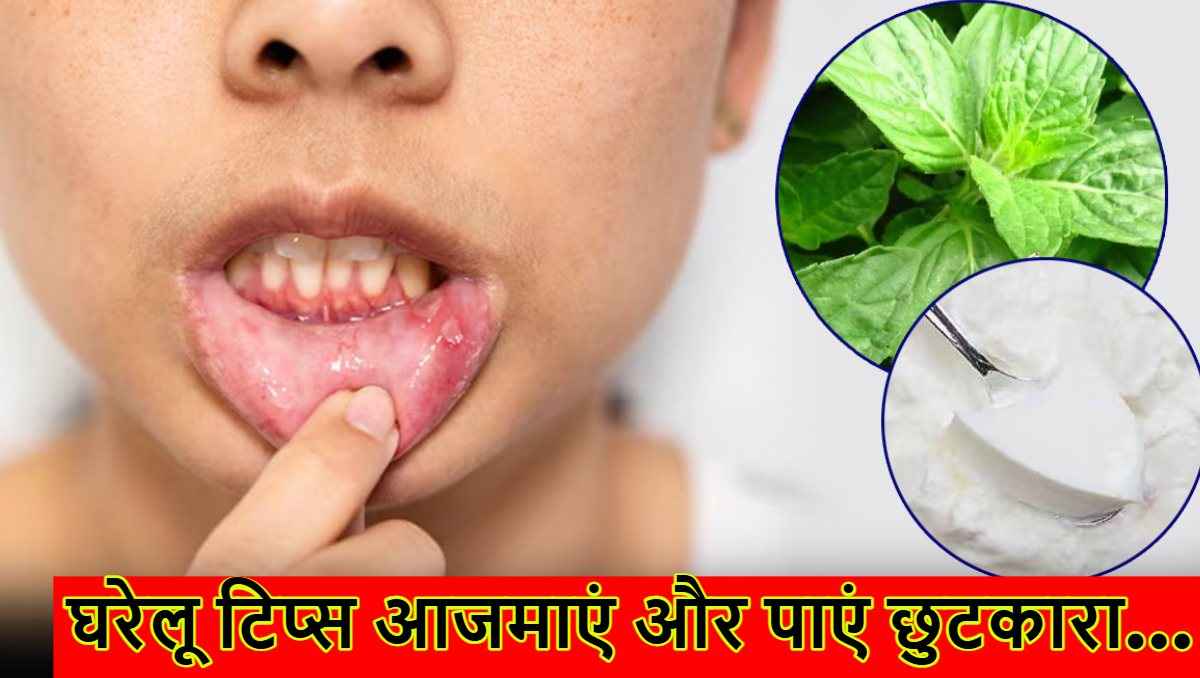 मुंह के छालों से आराम दिलाएंगे ये घरेलू उपाय, मिनटों में मिलेगी राहत