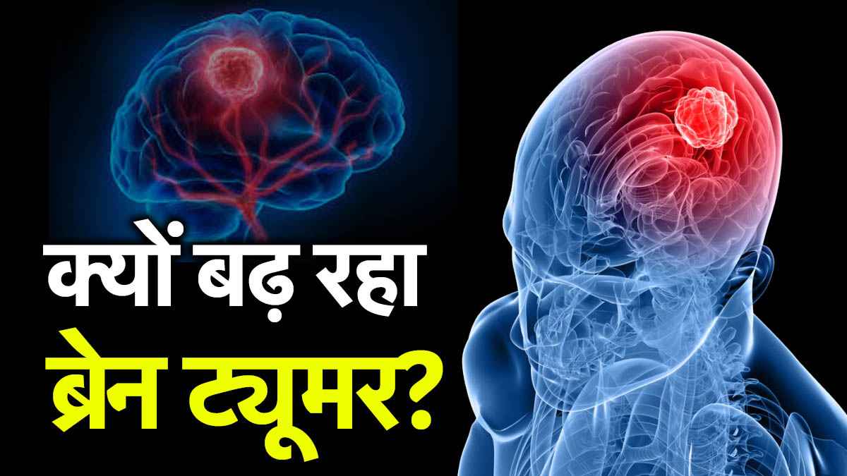 World Brain Tumor Day: भारत में तेजी से बढ़ रहा ब्रेन ट्यूमर का रिस्क, मामूली लक्षण भी जानलेवा, जानें डॉक्टर की राय