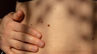 Mole On Stomach