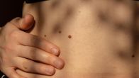Mole On Stomach