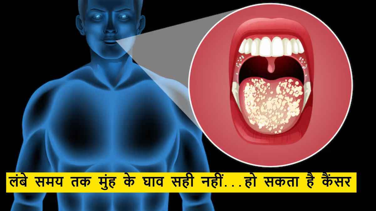सावधान! मुंह के ये अल्सर बन सकते हैं कैंसर का कारण, जानें डॉक्टर की राय