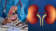 Kidney Diseases