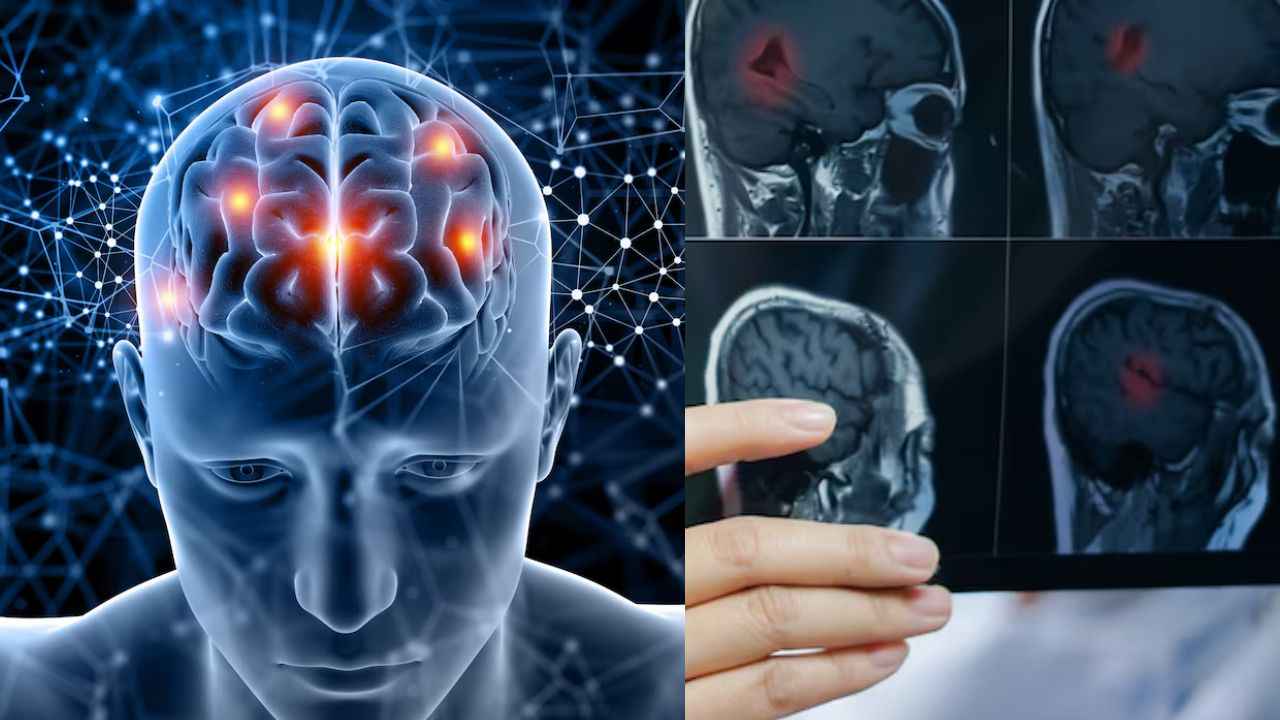 Tumors Symptoms: क्या सिरदर्द जैसे लगने वाले संकेत भी हो सकते हैं ट्यूमर, जानें क्या कहते हैं एक्सपर्ट