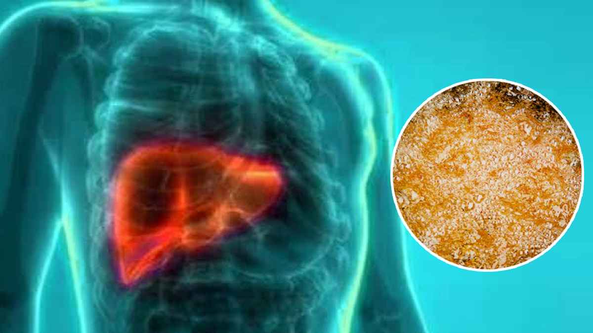 Fatty Liver Causes: फैटी लिवर होने पर ये चीजें बिल्कुल न खाएं, डॉक्टर ने दिए टिप्स