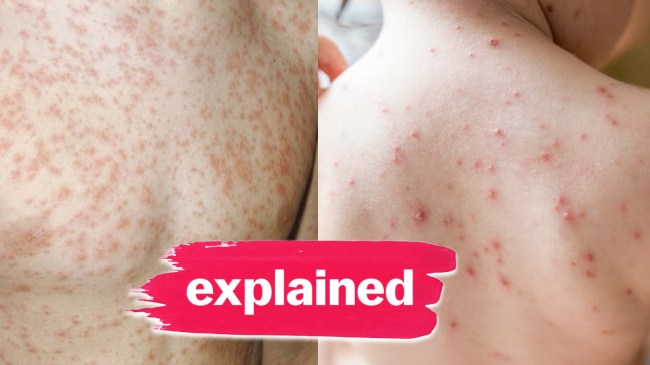 Measles and Rubella Disease