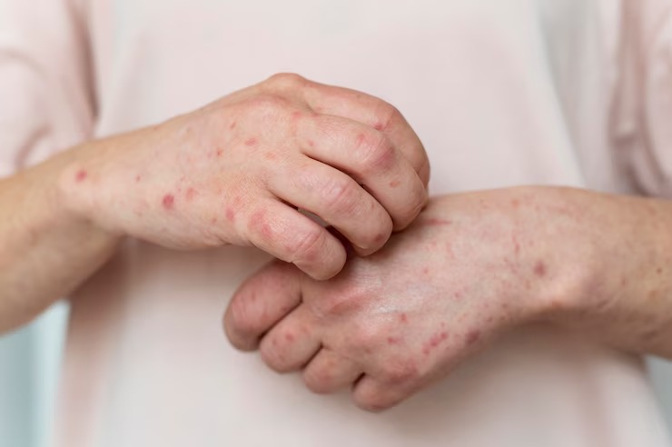 Measles and Rubella Disease