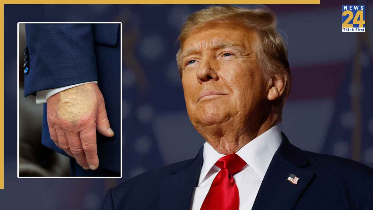 Donald Trump | US President | Health Update