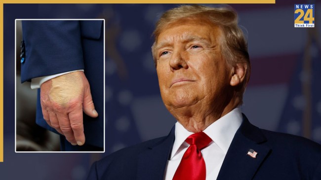 Donald Trump | US President | Health Update