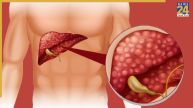 Liver Cancer Sympptoms