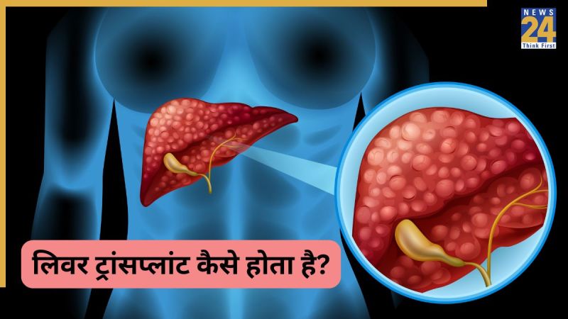 Liver Transplant
