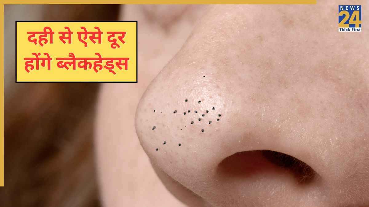 ब्लैकहेड्स से छुटकारा चाहिए तो दही में मिलाकर लगा लें ये चीज, आयुर्वेदिक एक्सपर्ट ने शेयर किया नुस्खा