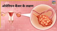 Ovarian Cancer
