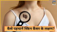 Skin Cancer