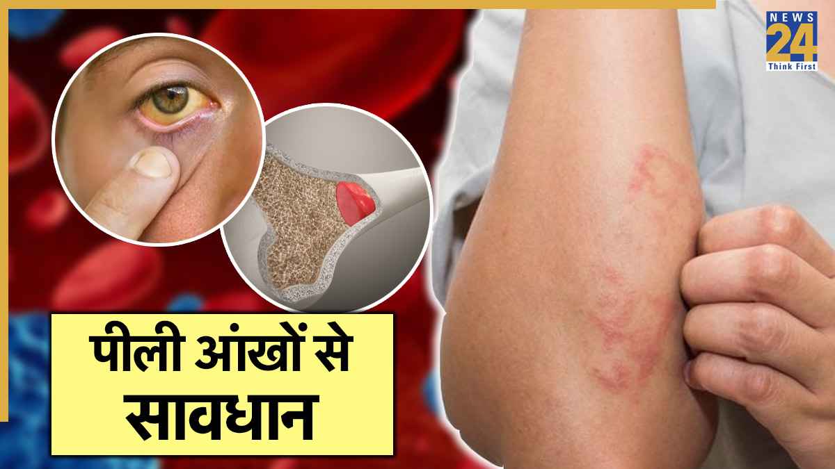 आंखों का पीला होना पीलिया ही नहीं इस कैंसर का भी है संकेत, एक्सपर्ट से जानें शुरुआती संकेत और उपाय