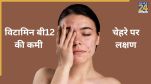 Vitamin B12 Deficiency