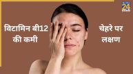 Vitamin B12 Deficiency