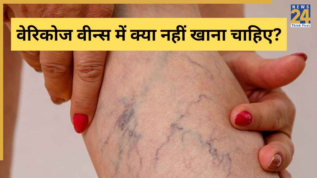 पैरों पर दिखती हैं नीली-हरी धारियां तो कभी ना खाएं ये चीजें, Varicose Vein स्पेशलिस्ट ने दी सलाह