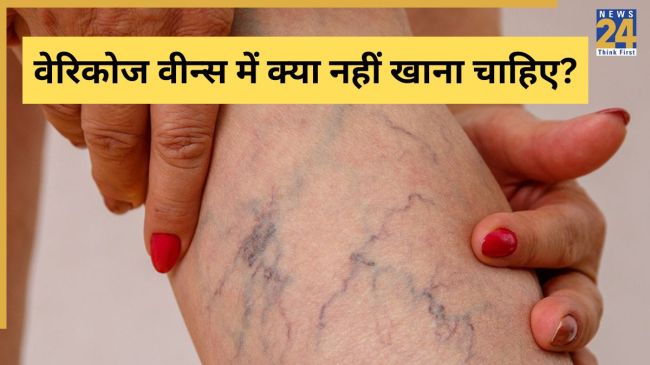 Varicose Veins Symptoms