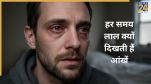 Red Eyes Causes