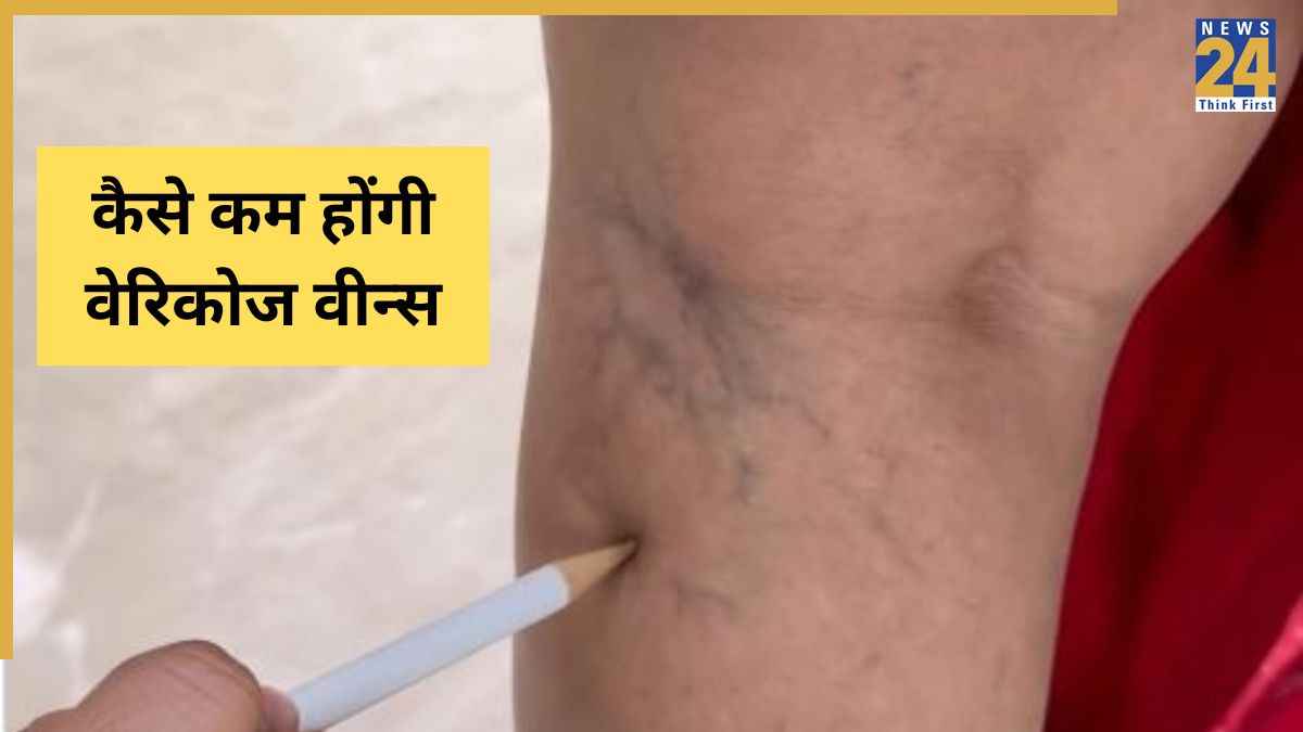 पैरों पर नीले-नीले मकड़ी के जाले जैसे निशान दिखते हैं? काइरोप्रैक्टर ने कहा Varicose Veins से निकल जाएगा गंदा खून
