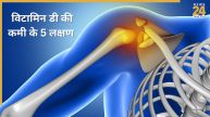 Vitamin D Deficiency