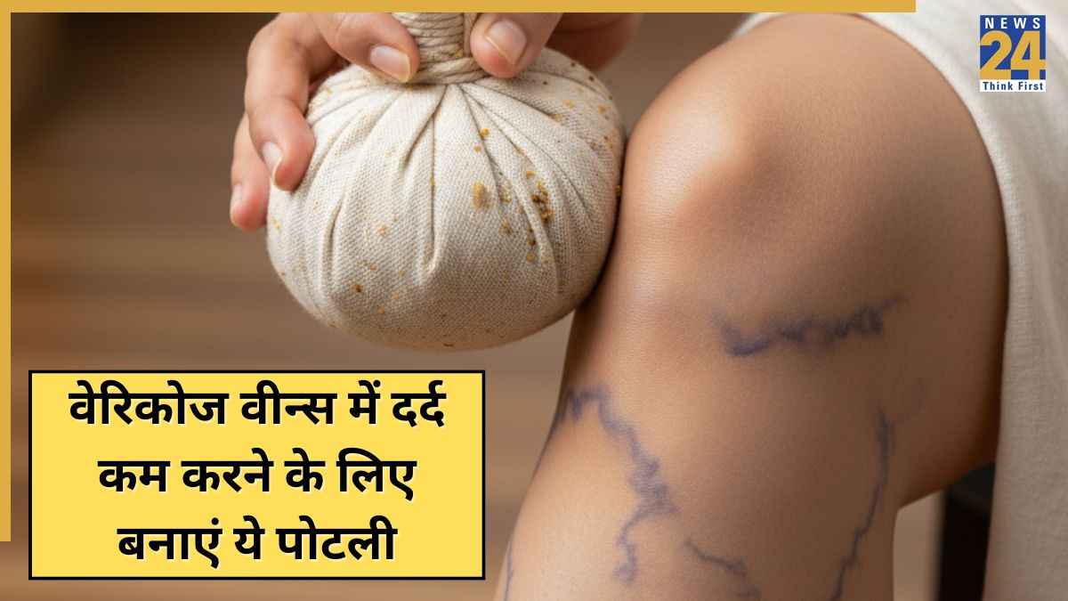 Varicose Veins से परेशान हैं तो बनाएं यह पोटली और करें सिंकाई, दर्द कम कर देगा एक्सपर्ट का बताया यह आयुर्वेदिक नुस्खा