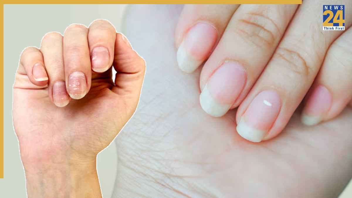 White-Spots-on-Nails