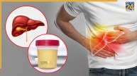 fatty liver signs