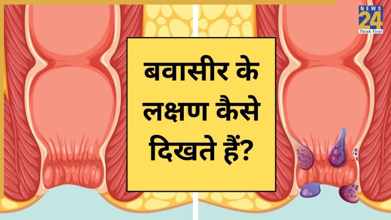 Bawasir Bawasir Ke Lakshan-1