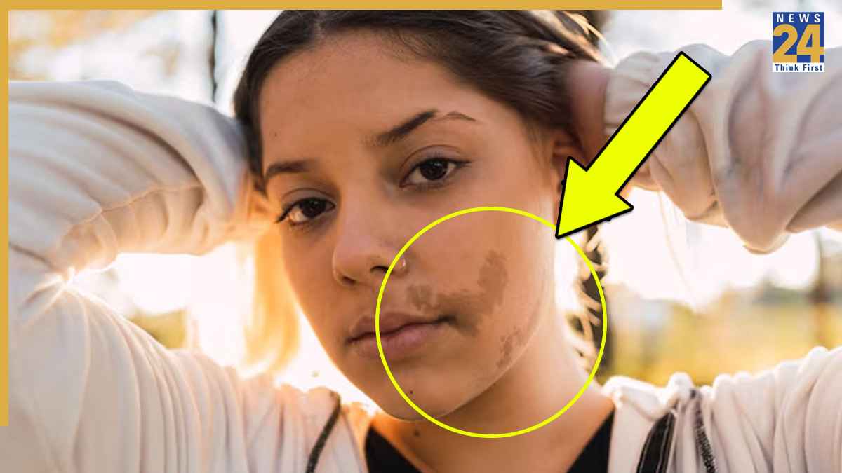 Birthmark On Face Spiritual Meaning