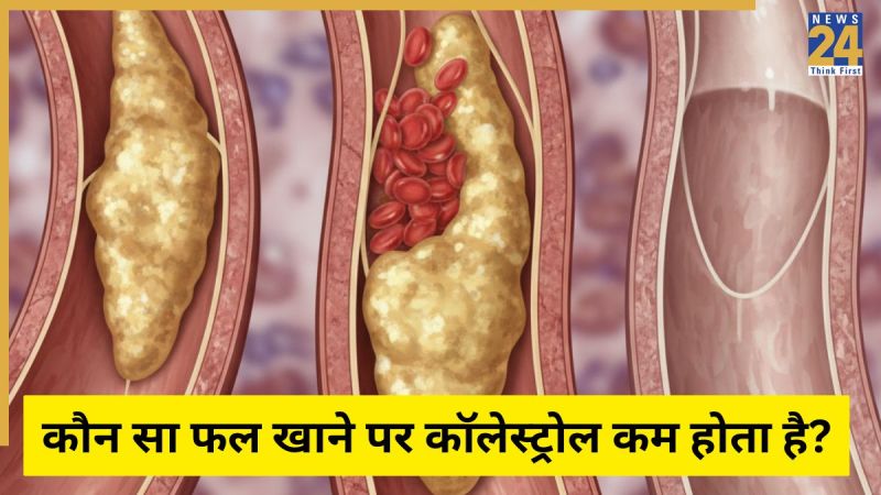 Cholesterol Cholesterol Diet