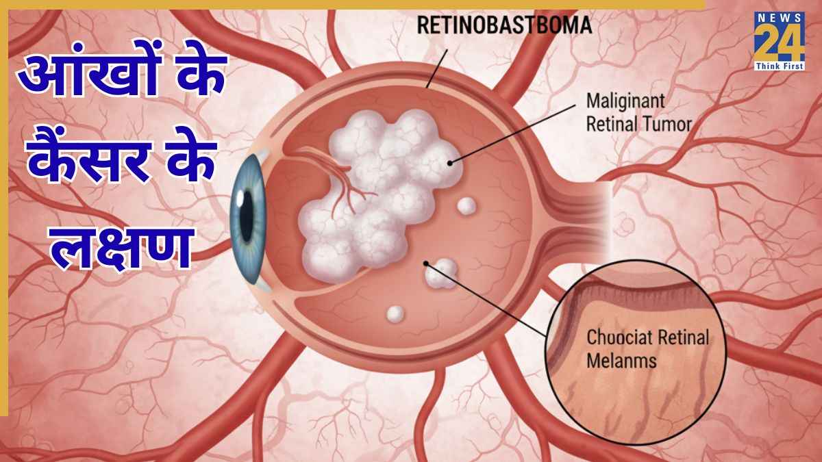 Eye Cancer