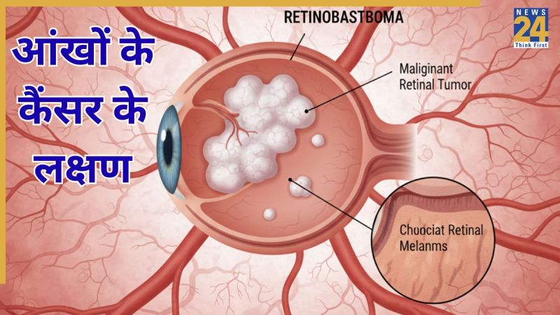 Eye Cancer Eye Cancer