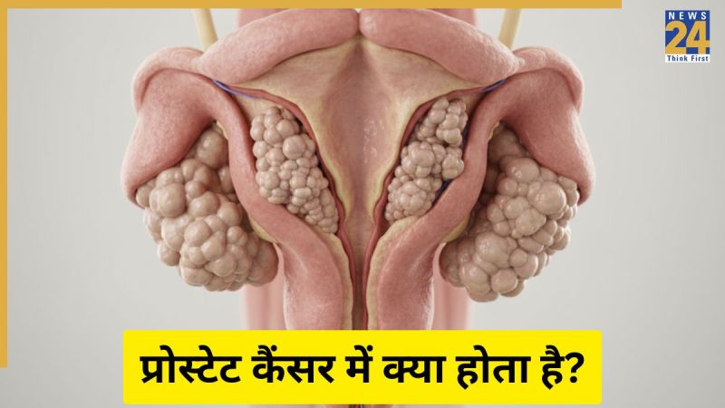 Prostate Cancer Prostate Cancer