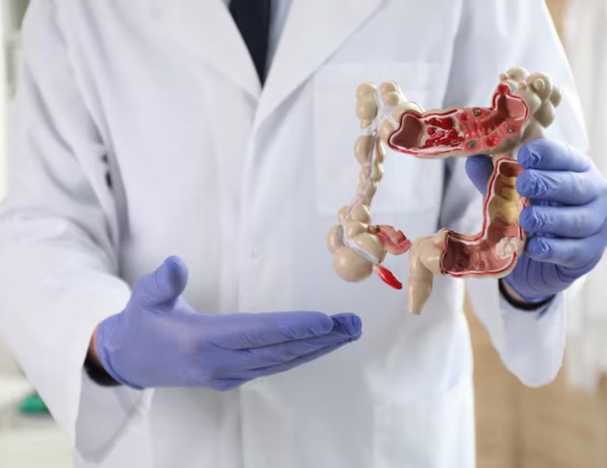 Colon cancer symptoms-1-2