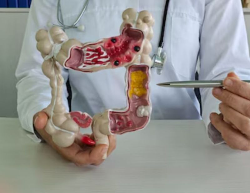 Colon cancer symptoms Colon cancer symptoms-1-2-3