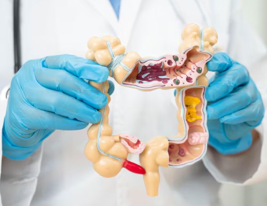 Colon cancer symptoms-1-2-3-4