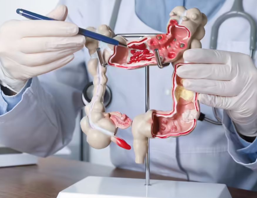 Colon cancer symptoms-1-2-3-4-5