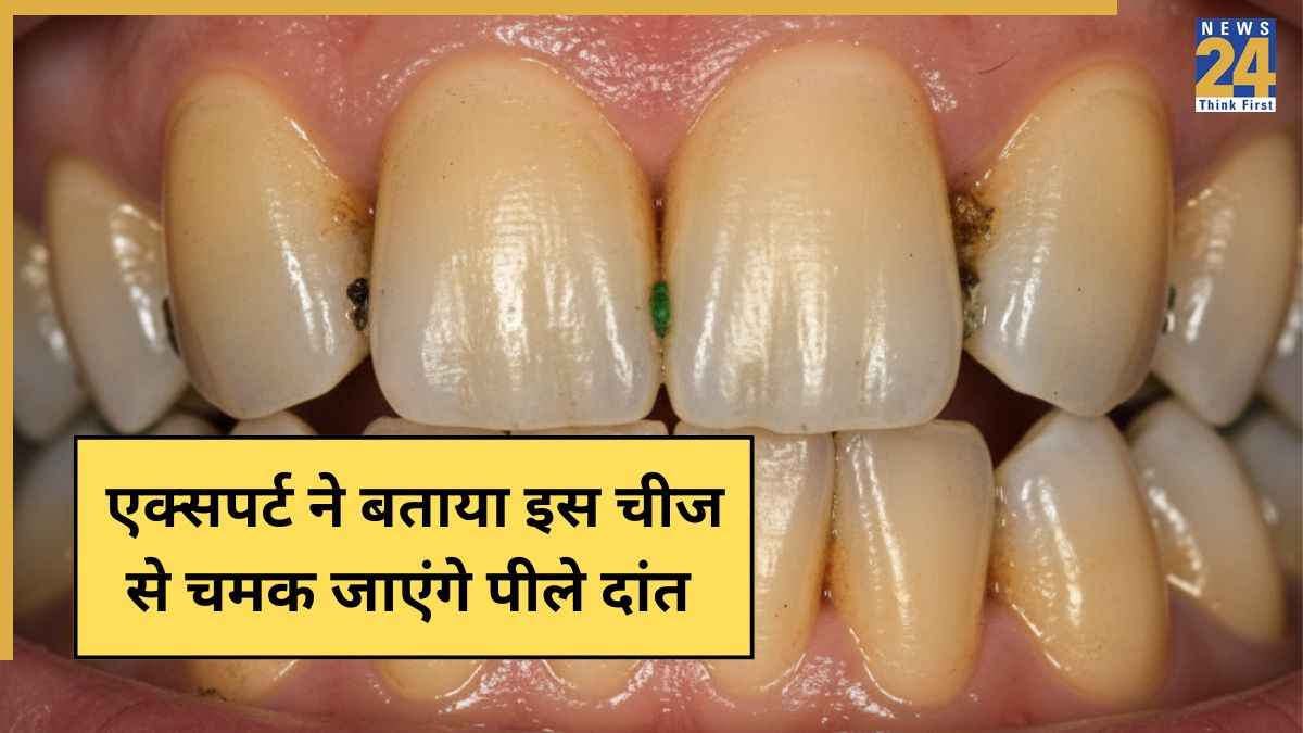 Yellow teeth