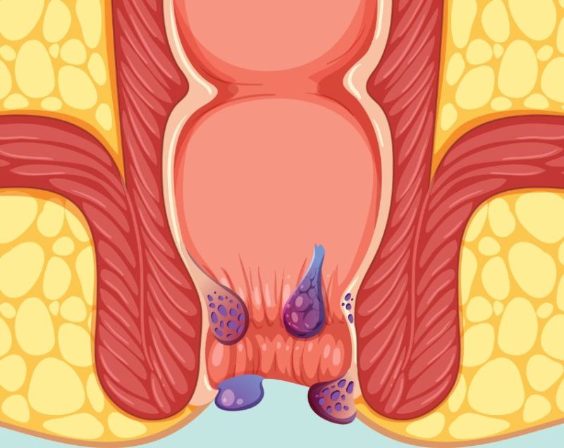 Bawasir Bawasir Ke Lakshan-1-2-3