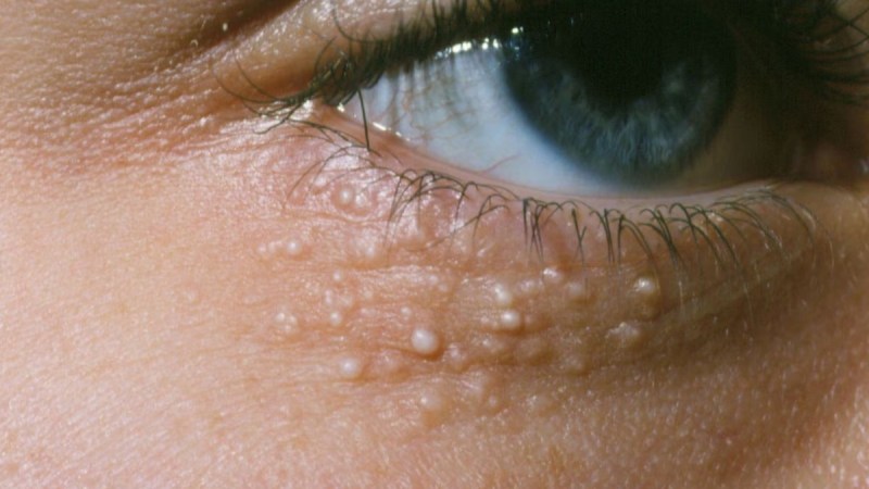 source-high cholesterol symptoms -1-2