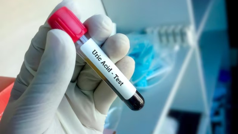 source- uric acid uric acid-1-2-3-4-5-6-7-8