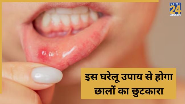 Mouth Ulcer Home Remedy