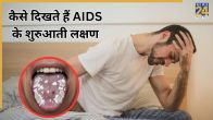 AIDS Symptoms