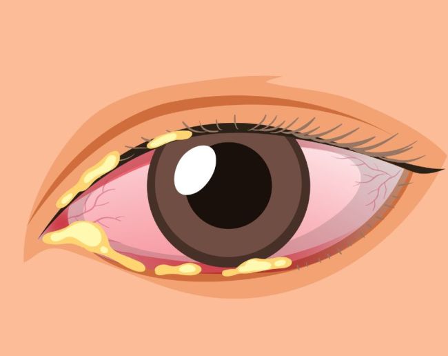 Aankh me kichad kyu aata hai-1-2