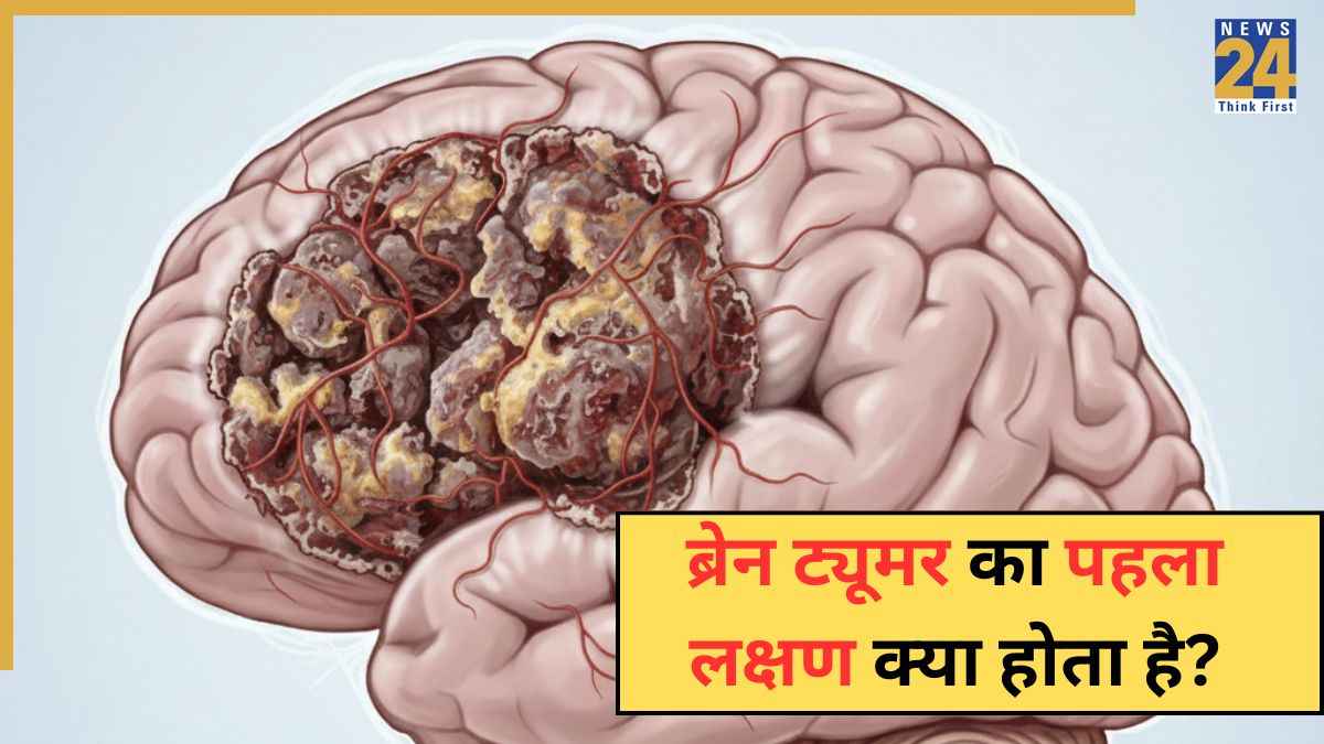 Brain Tumor का पहला लक्षण क्या होता है? मेदांता अस्पताल के डॉक्टर ने बताया कैसे पता चलेगा कि सिरदर्द ब्रेन ट्यूमर है