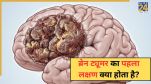 Brain Tumor